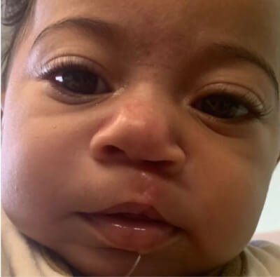 Cleft-Surgery-After