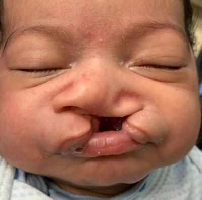 Cleft-Surgery-Before